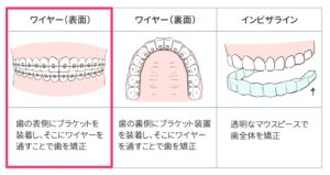八重歯の全体矯正の表2